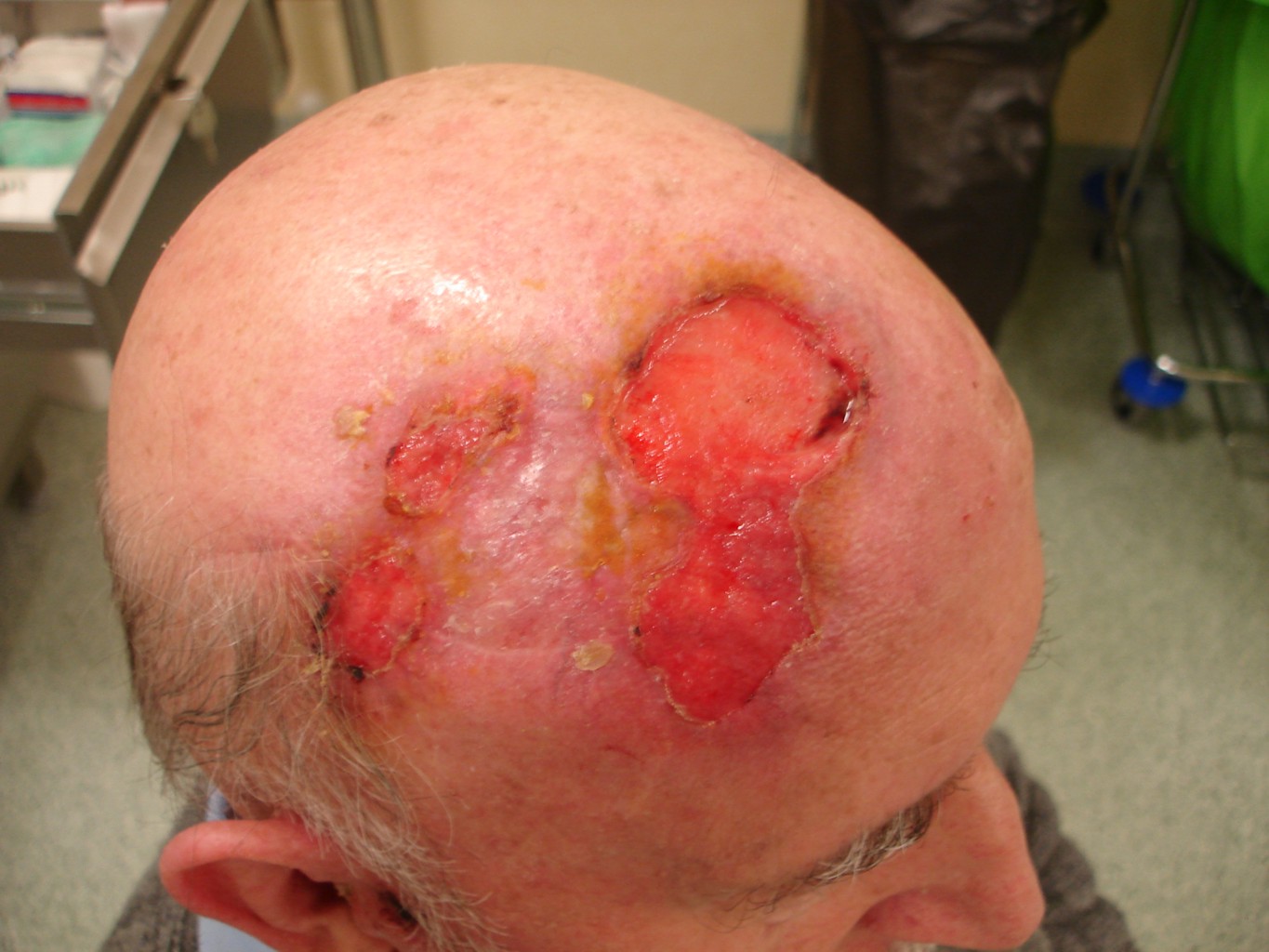 Rak podstawnokomórkowy skóry głowy