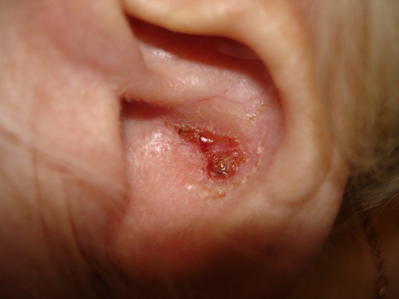 Rak podstawnokomórkowy skóry ucha