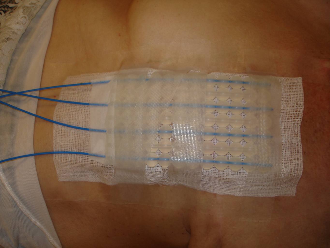Aplikator do brachyterapii kontaktowej - cewniki typu French mocowane w aplikatorze Freiburg (kulki), przymocowany w okolicy napromienianej
