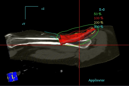 Planowanie 3D PLATO - przekrój podłużny, widoczny CTV, rozkład izodoz