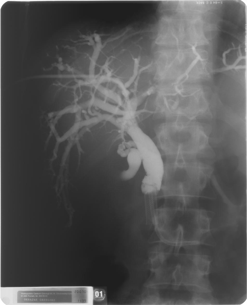 Cholangiografia - widok dróg żółciowych przed implantacją aplikatora do brachyterapii (French 5), założono dren 10 F metodą rendez-vous, widoczny stent