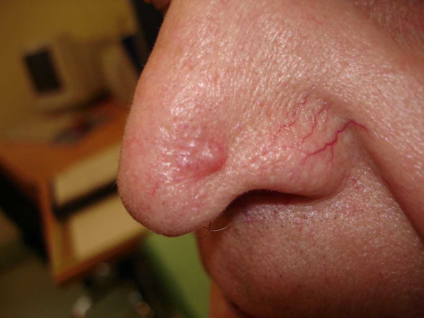 Rak kolczystokomórkowy skóry nosa