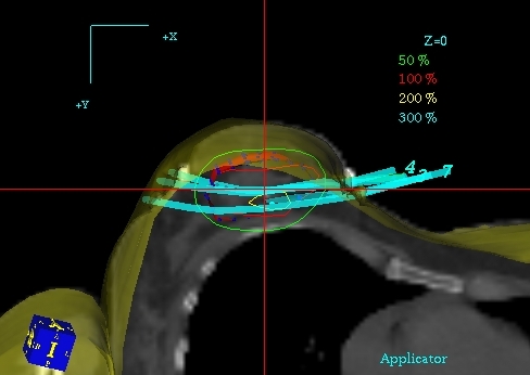 Plan leczenia przygotowany przy pomocy systemu planowania PLATO - wizualizacja aplikatorów 3D - przekrój poprzeczny, widoczne izodozy (dawka 100% - dawka założona) oraz aplikatory. Dawka w narządach krytycznych (płuco, skóra) poniżej 50% dawki w CTV