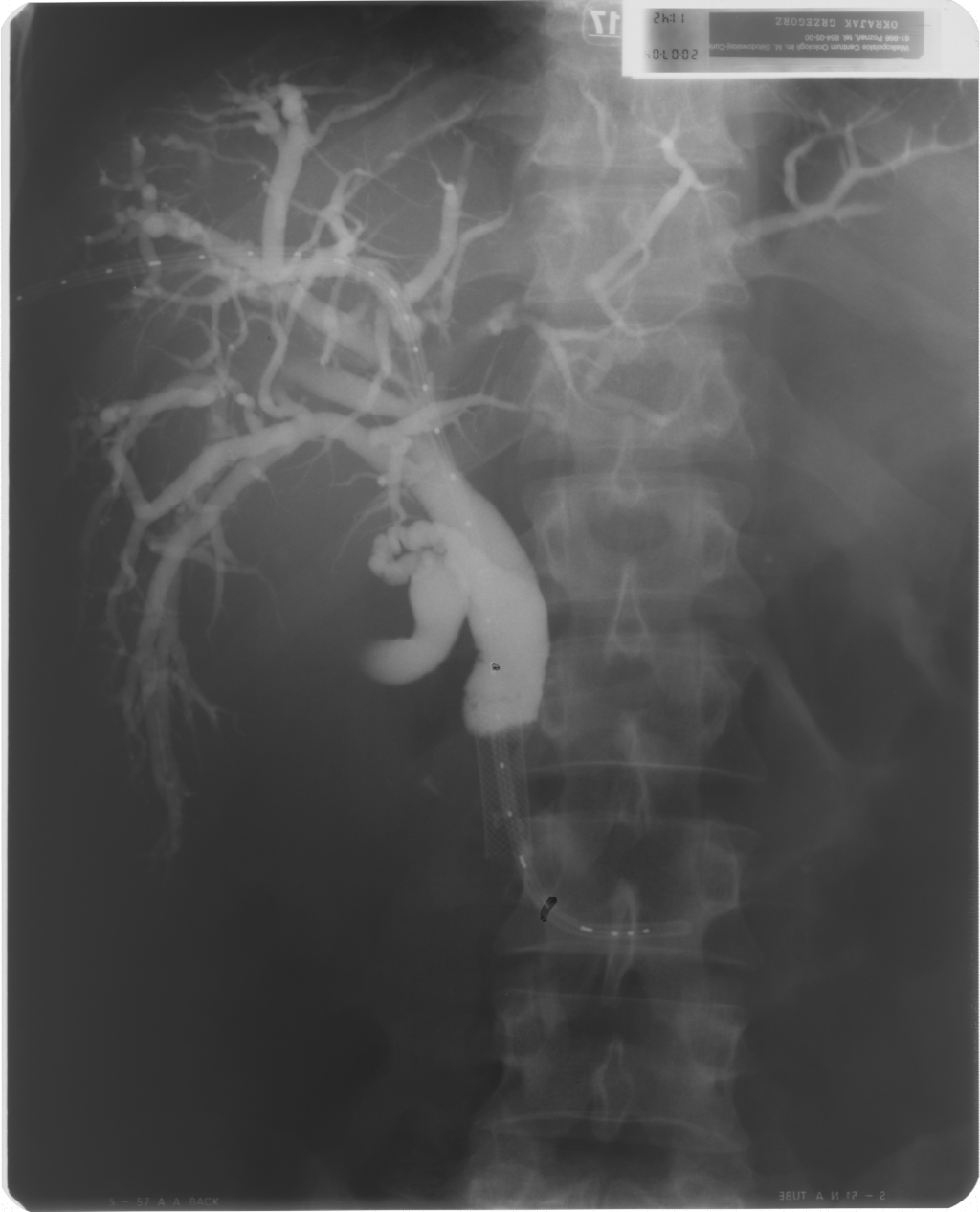 Cholangiografia - widok dróg żółciowych po implantacji aplikatora (French 5) do brachyterapii, założono dren 10 F metodą rendez-vous, widoczny stent