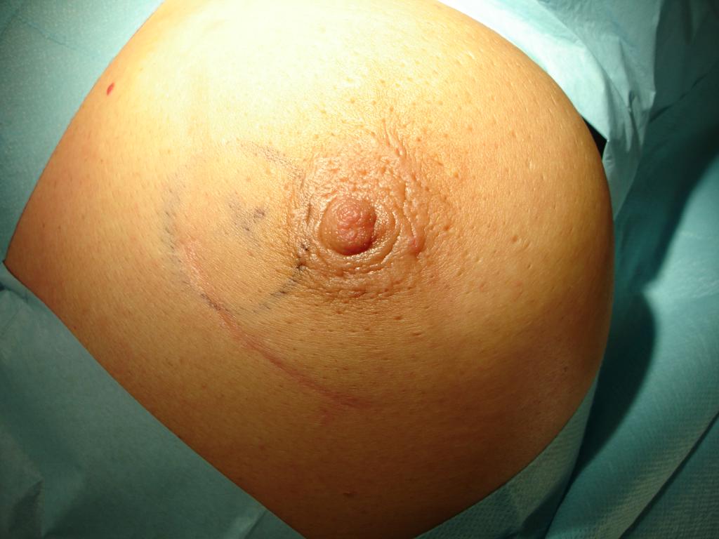 Obraz blizny po tumorektomii, zaznaczone położenie klipsów weryfikowane obrazem rtg