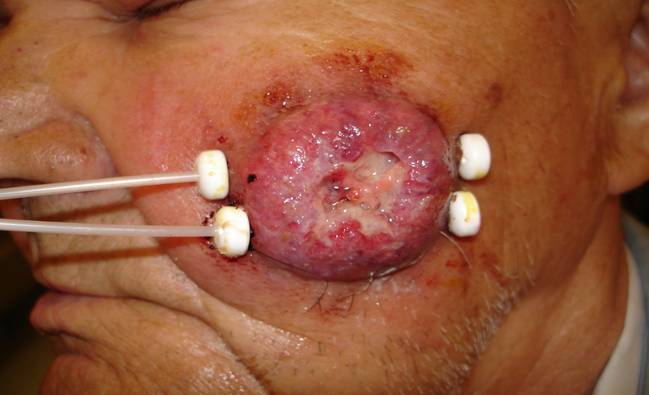 Rak płaskonabłonkowy skóry policzka. Załozone aplikatory śródtkankowe do brachyterapii.