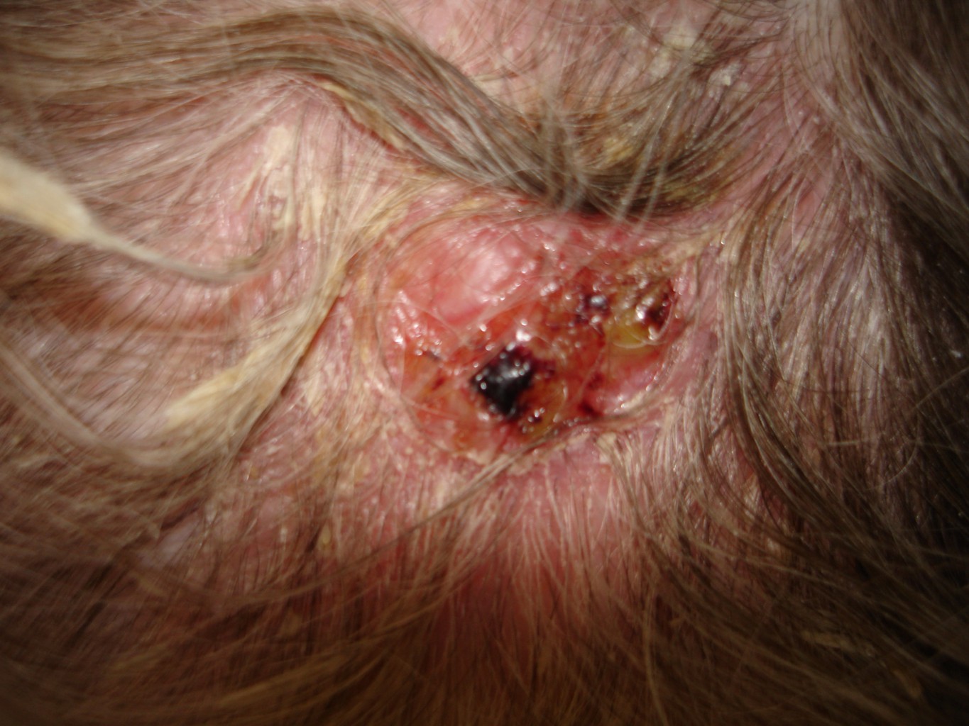 Rak kolczystokomórkowy skóry głowy