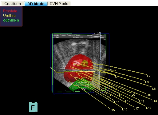 Obraz igieł 3D - widoczny zarys USG gruczołu krokowego (kolor czerwony)