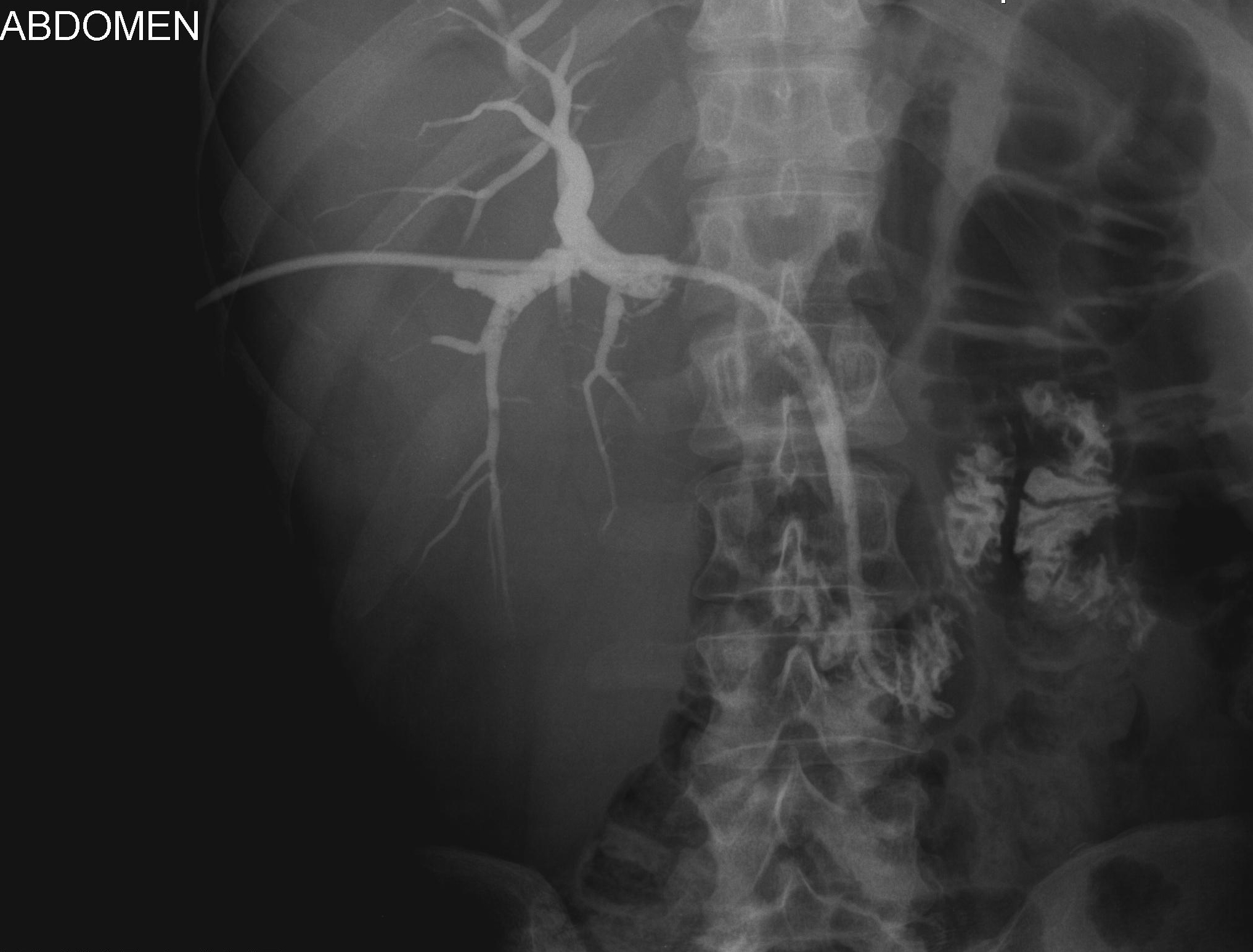 Cholangiografia - widok dróg żółciowych przed implantacją aplikatora do brachyterapii, założono dren 10 F metodą rendez-vous.